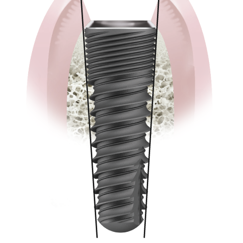 IMG Implants naturactis conicite1