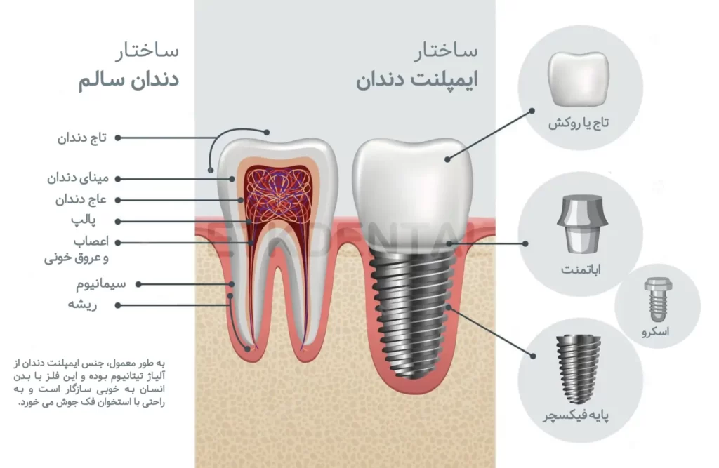 اجزای تشکیل دهنده ایمپلنت دندان