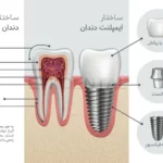 اجزای تشکیل دهنده ایمپلنت دندان